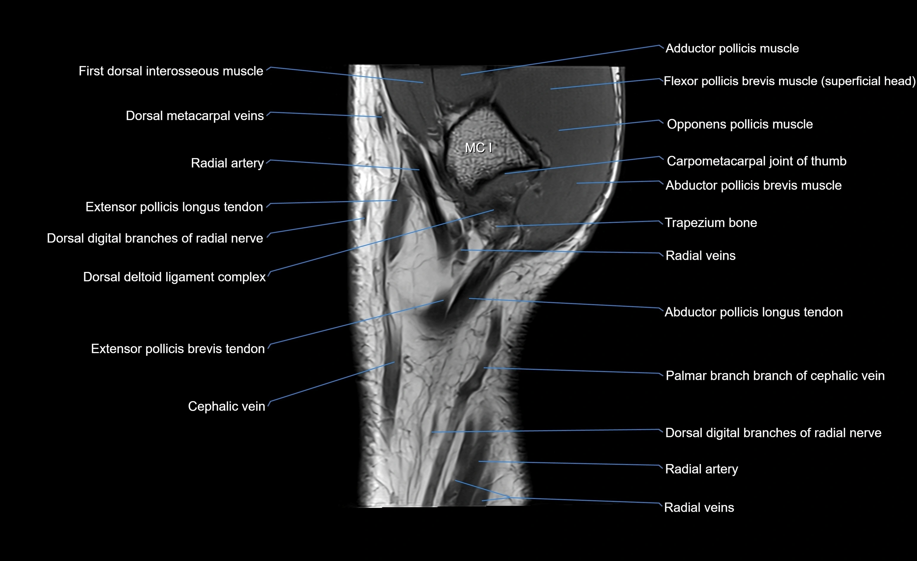 MRI wrist sagittal cross sectional anatomy 3T  radiology  image-img-00001-00003.webp